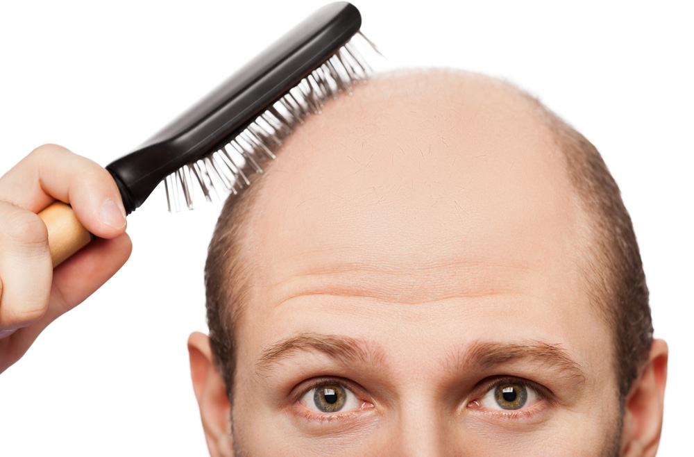 going-bald-here-s-what-you-need-to-know-about-hair-loss